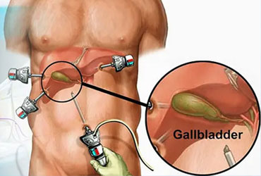 Bariatric Surgery